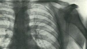 A rubber catheter pushed more than two feet up an arm vein reached a beating heart in a small German hospital, and the x-ray that proved it later earned medicine's highest honor 22 Catheter tube entering an arm vein toward a beating heart in a 1929 hospital