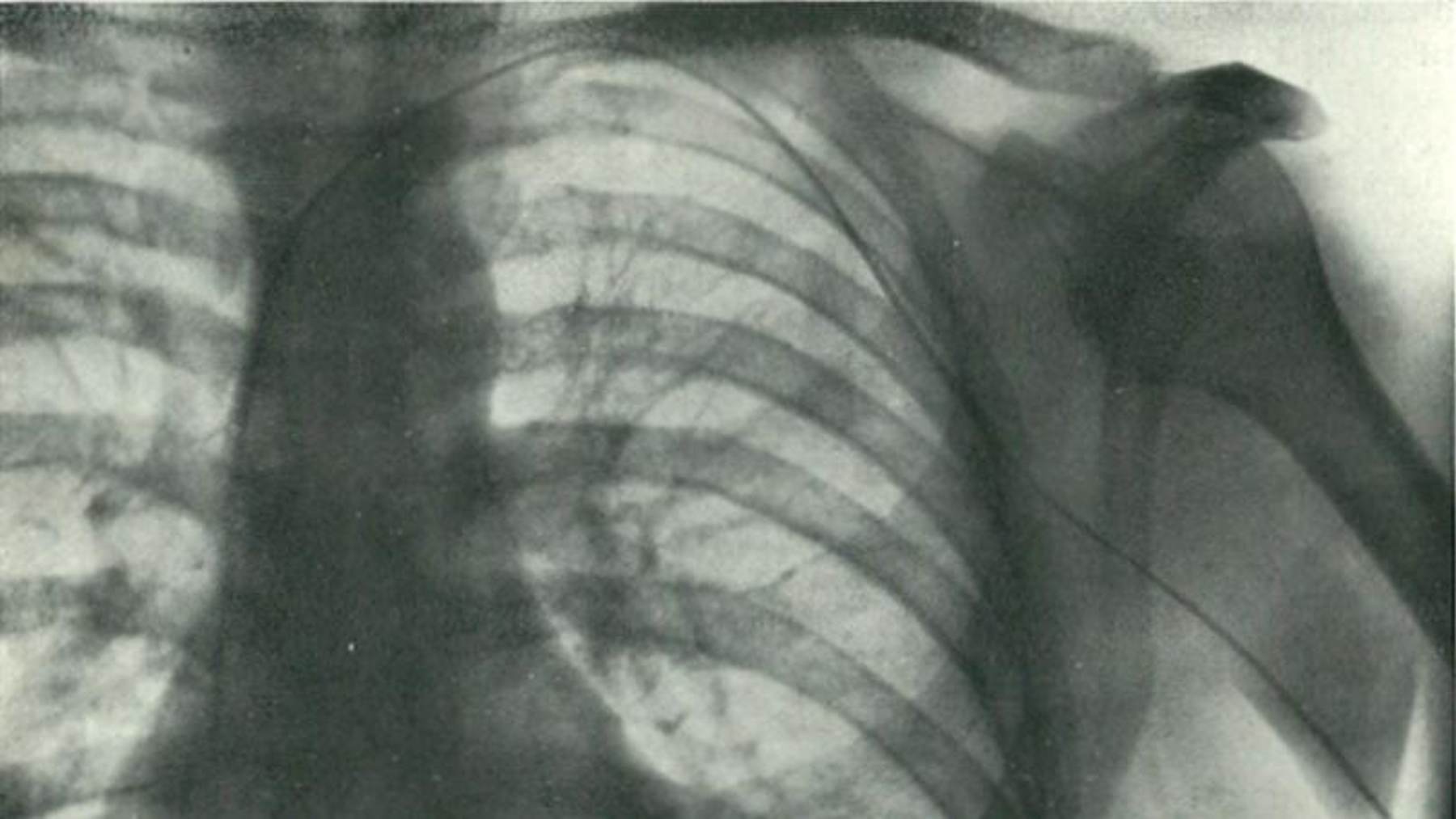 Catheter tube entering an arm vein toward a beating heart in a 1929 hospital