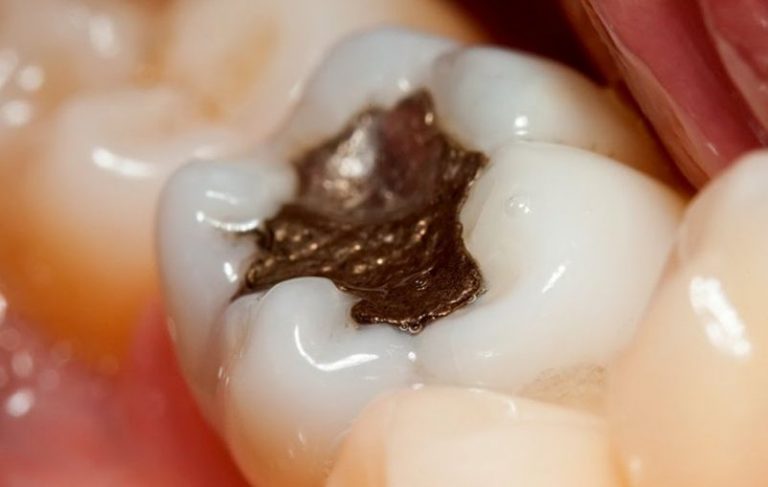 Mercurio en odontología, fuertes prohibiciones en la UE y Estados Unidos 1 Mercurio en odontología, fuertes prohibiciones en la UE y Estados Unidos