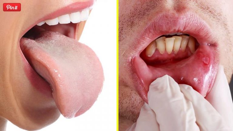 5 cosas que tu boca puede revelarte sobre tu salud 3 5 cosas que tu boca puede revelarte sobre tu salud