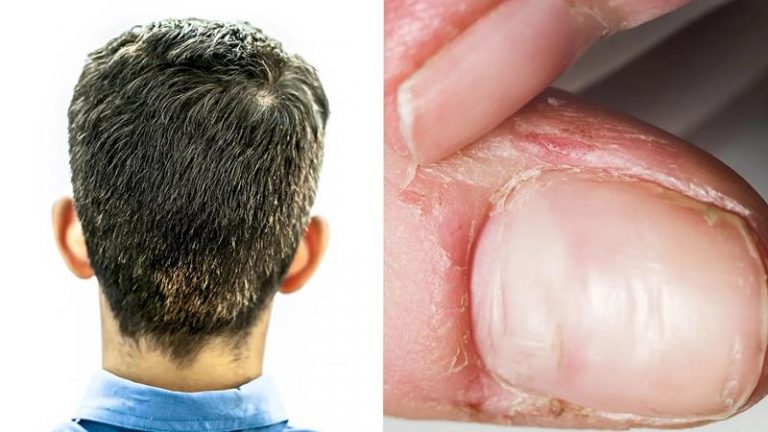 10 señales de deficiencia de vitaminas. Qué deberías hacer 10 10 señales de deficiencia de vitaminas. Qué deberías hacer