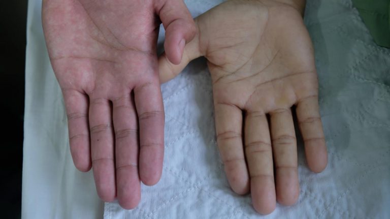 15 síntomas de anemia que nunca debes ignorar 1 15 síntomas de anemia que nunca debes ignorar