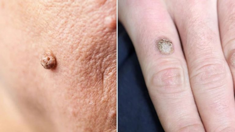 Cómo quitar las verrugas y los acrocordones de forma natural y permanente 7 Cómo quitar las verrugas y los acrocordones de forma natural y permanente