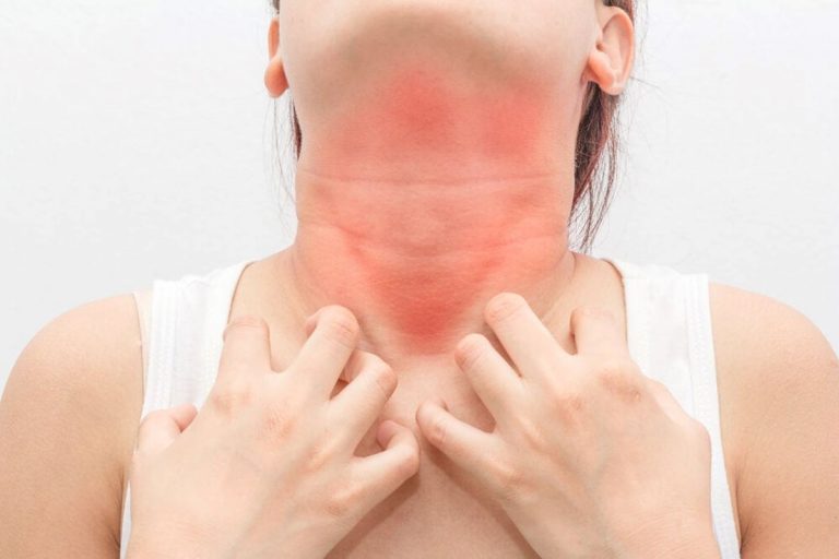 Inmunoterapia ad-hoc ¿Es posible curarte tu mismo una alergia alimentaria? 4 Inmunoterapia ad-hoc ¿Es posible curarte tu mismo una alergia alimentaria?