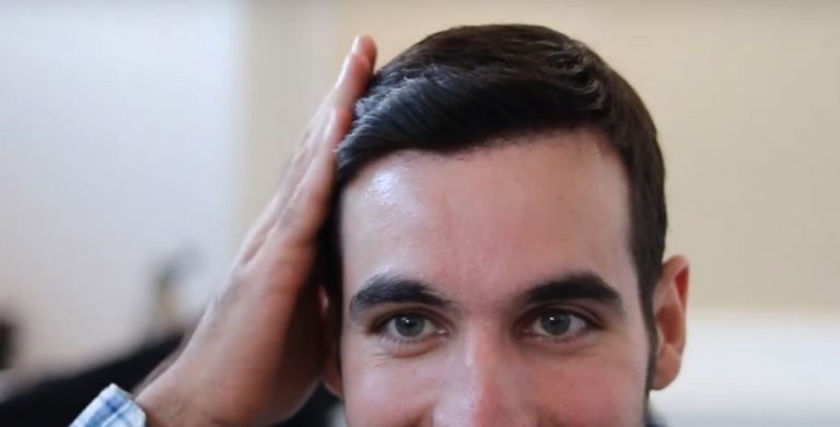Conozca diferentes soluciones para la caída del cabello 2 Conozca diferentes soluciones para la caída del cabello