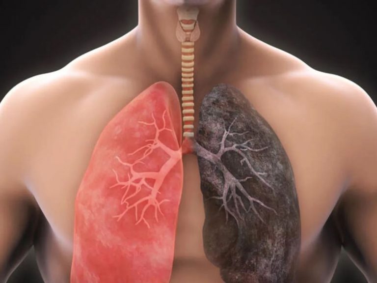 Receta de jarabe para limpiar los pulmones de nicotina y la contaminación 9 Receta de jarabe para limpiar los pulmones de nicotina y la contaminación