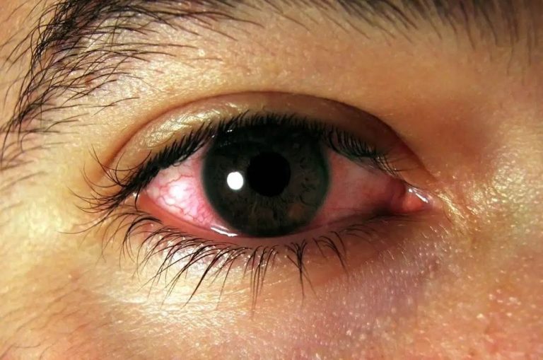 Enfermedad del ojo seco podría provocar un deterioro de la salud en general 4 Enfermedad del ojo seco podría provocar un deterioro de la salud en general