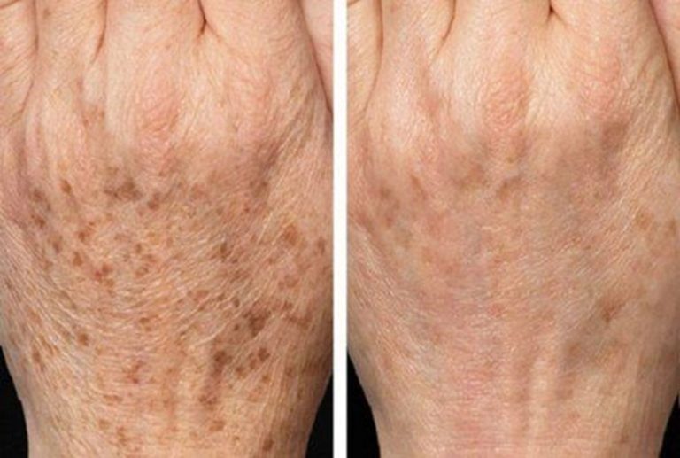 Cómo reducir manchas de la edad de forma natural 6 Cómo reducir manchas de la edad de forma natural