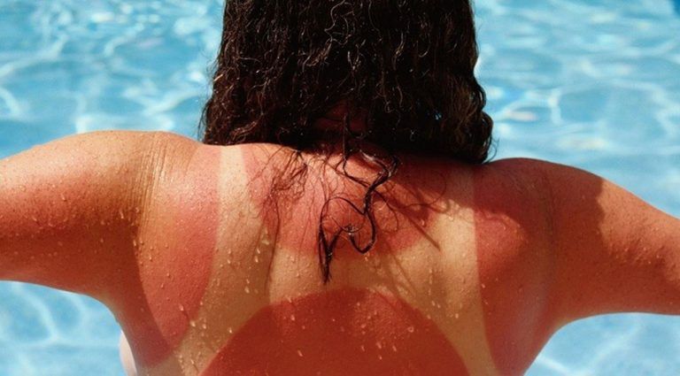 Quemaduras del sol: 7 remedios naturales para combatirlas 10 Quemaduras del sol: 7 remedios naturales para combatirlas