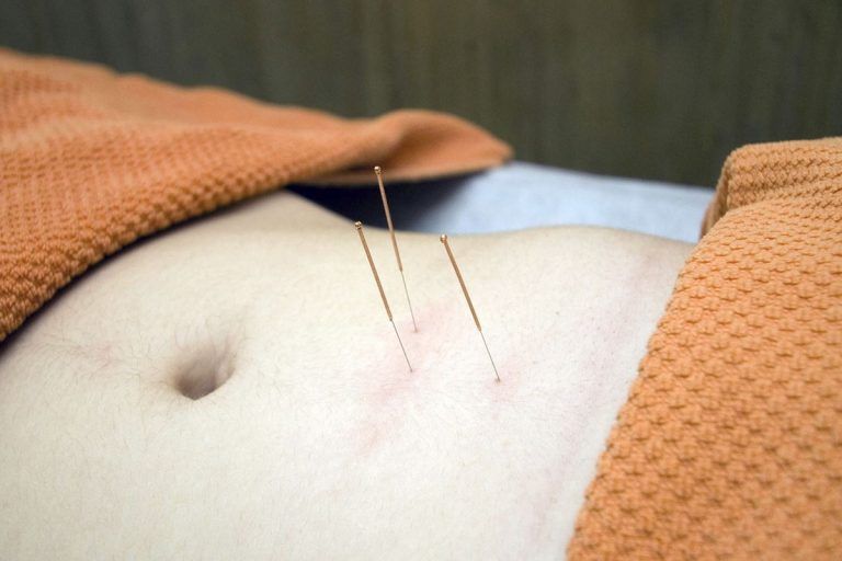 ¿Para que sirve la acupuntura? 1 ¿Para que sirve la acupuntura?