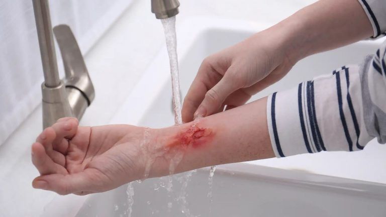 ¿Cómo tratar las quemaduras de forma natural? 2 ¿Cómo tratar las quemaduras de forma natural?
