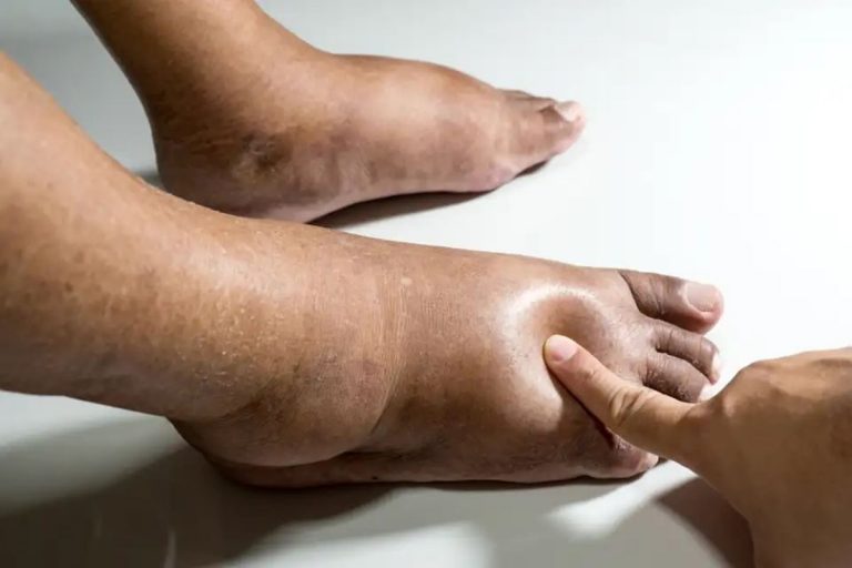 Retención de agua en el cuerpo. Causas y soluciones 8 Retención de agua en el cuerpo. Causas y soluciones