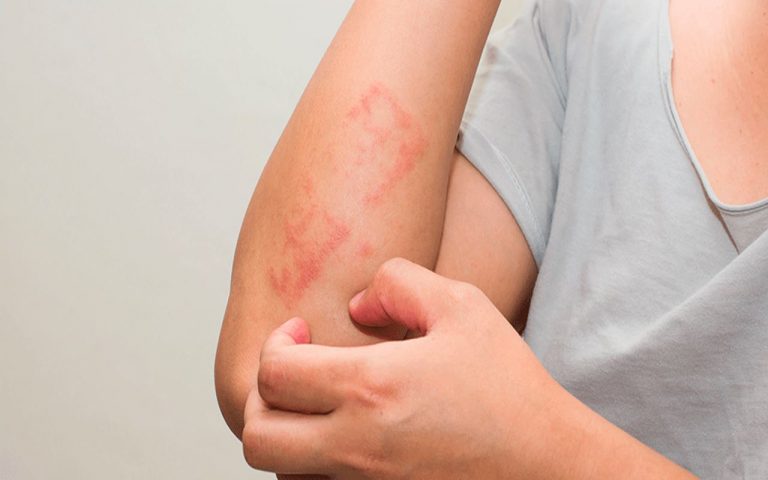 10 remedios caseros fáciles para el eczema (dermatitis atópica) 6 10 remedios caseros fáciles para el eczema (dermatitis atópica)