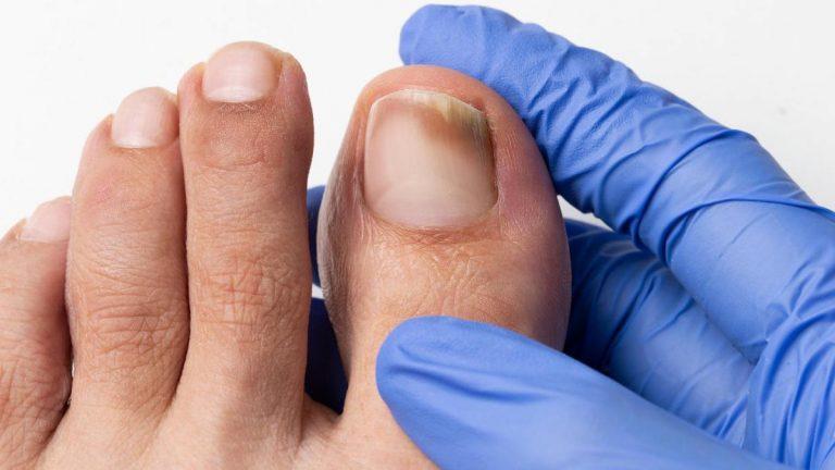 Qué causa los hongos en las uñas de los pies y cómo solucionarlo 2 Qué causa los hongos en las uñas de los pies y cómo solucionarlo