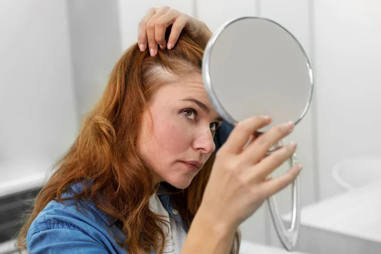 Tipos de alopecia y drogas que causan caída del cabello 8 Tipos de alopecia y drogas que causan caída del cabello