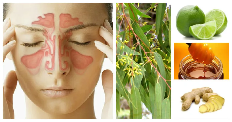 Cómo tratar naturalmente la sinusitis 3 Cómo tratar naturalmente la sinusitis