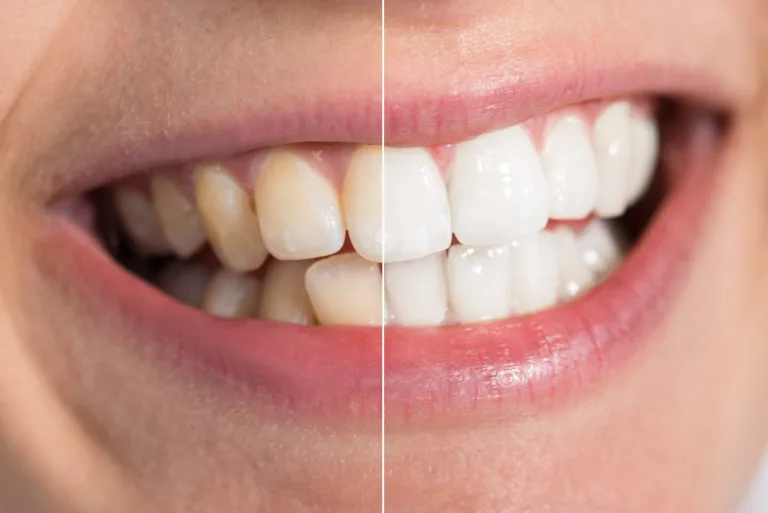2 ingredientes de cocina para eliminar el sarro dental 4 2 ingredientes de cocina para eliminar el sarro dental