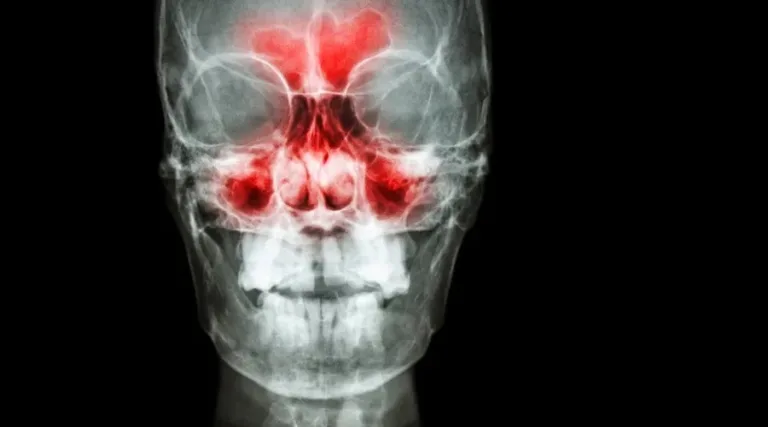 5 remedios naturales infalibles para aliviar la sinusitis y respirar mejor