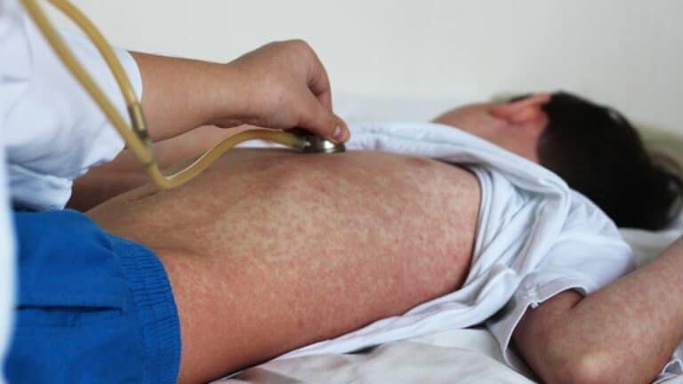 Aumenta la alerta epidemiológica por nuevos casos de Sarampión en México 5 Aumenta la alerta epidemiológica por nuevos casos de Sarampión en México